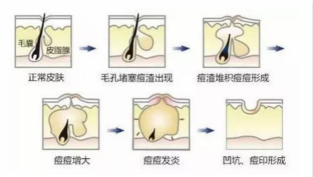 NEWNEW|修復(fù)痘坑痘印還得靠海藻煥膚