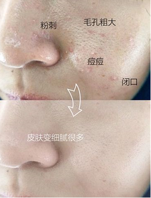 被粉刺、黑頭、毛孔、角質(zhì)糾纏？千萬別忽視深層清潔！