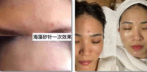 排出炎癥，治愈痘痘粉刺