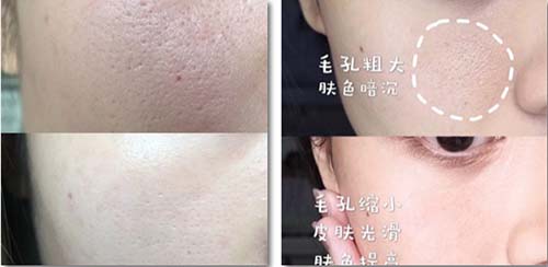 收縮毛孔、祛除皺紋
