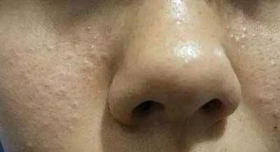 皮膚吸收不暢、粉刺痘痘不斷，是時候做下深層清潔了