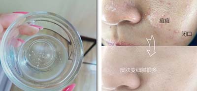 皮膚吸收不暢、粉刺痘痘不斷，是時候做下深層清潔了