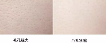 VN皮膚管理：什么皮膚問題適合做海藻煥膚？